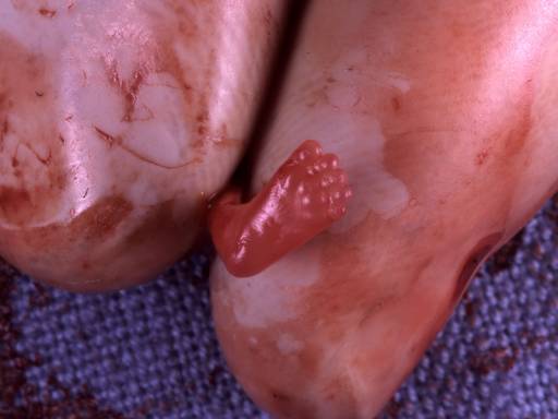 Abortoidun lapsen jalka (8 viikko hedelm�ityksest�)